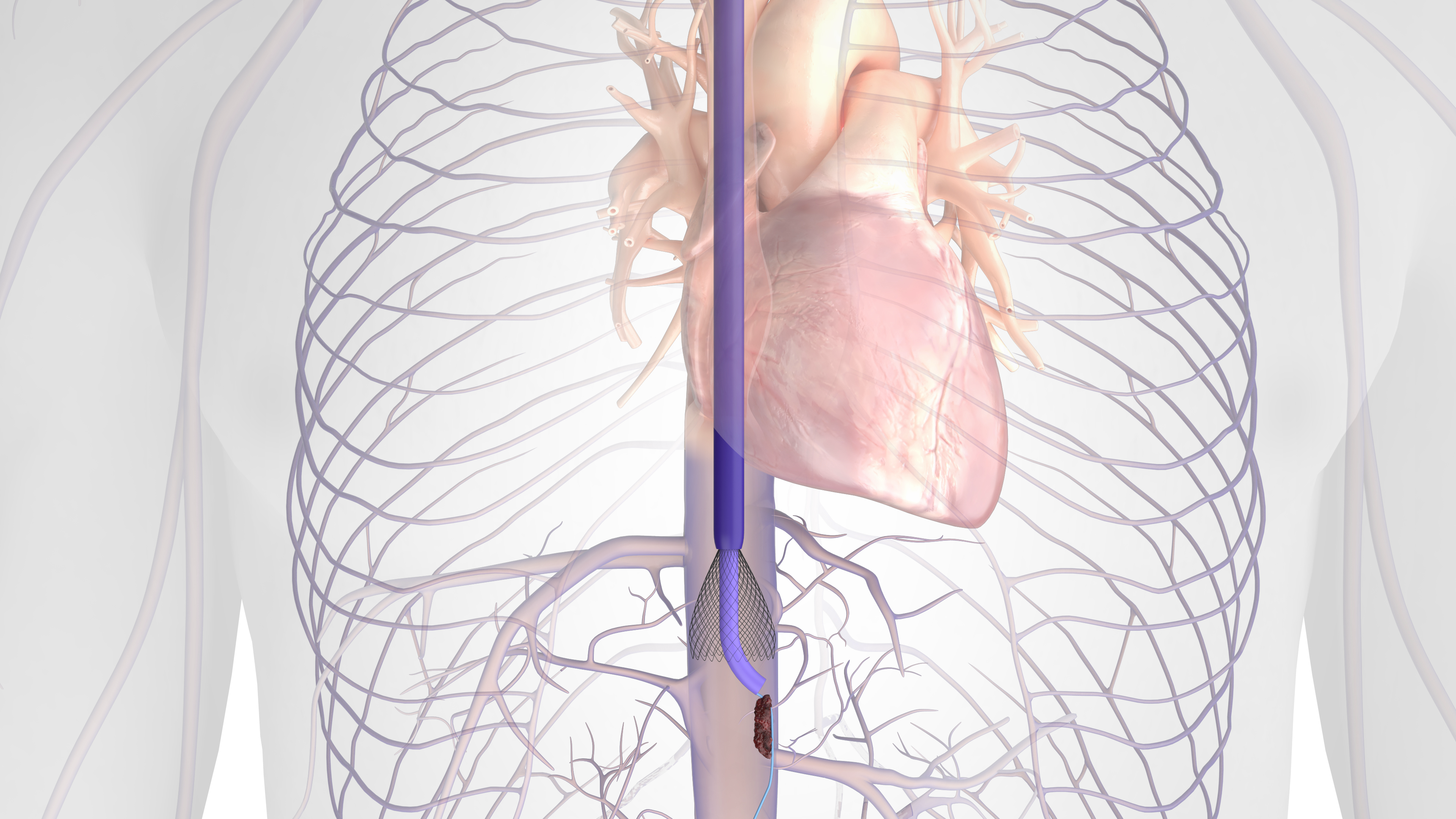 Protrieve Sheath Inari Simplifying Complex DVT Thrombectomy Cases | VDM